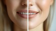 © Alpha - Blog post with visual timeline of mouth wrinkle treatment results, comparing various options like chemical peels and fillers, close-up before-and-after images, Realistic, Soft Focus
