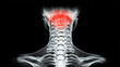 © Marketplace - X-ray image showing the human cervical spine with highlighted area indicating potential injury or discomfort at the neck region.