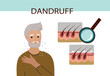 © Olga - Portrait of elderly man with problem of dandruff. Infographic. Health medicine, trichology, dermatology concept. Vector hand drawn flat cartoon illustration.