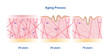 © Mosterpiece - Cross section of aging process skin comparison vector illustration isolated on white background. High density, depletion and low density of collagen, elastin fibers and fibroblasts in the dermis.