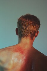 A person with sunburn on their back, a photograph of the skin discoloration caused by ultraviolet rays from sunlight. generative ai