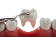 © venusvi - Dental treatment process with a dentist tool extracting or filling a tooth.