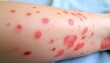 © Kromstar Studios - Blistering rash on arm or leg, possibly chicken pox with copy space