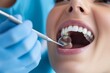 © vasyan_23 - Close-up of dental examination with dentist using mirror on patient's open mouth