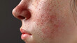 © Best - Eczema (Atopic Dermatitis): A chronic skin issue defined by dryness, itchiness, and inflammation, often triggered by environmental factors or allergic reactions.