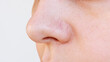 © Марина Демешко - Close-up of young woman's nose with black heads or black dots on a white background. Acne problem, comedones. The girl with enlarged pores on the face. Blackheads on greasy skin
