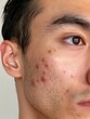 © Anna - Close-up of acne and skin texture on a young man's face