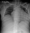 © Radiographs - Radiographic Chest X-Ray: Key Diagnostic Tool for Lung and Heart Assessment