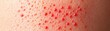 © IYearDesign - Close-up of red, tender hives across skin, highlighting tingling and sensitivity, dermatology focus on allergic response
