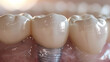 © Mila Frolova - dental implant, tooth implant, dentistry, oral health, dental surgery, implantology, prosthetic tooth, oral hygiene, dental anatomy, tooth restoration, oral care, dental treatment, medical illustratio