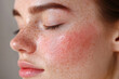 © AnastasiiaAkh - rosacea and freckles on a woman's face close-up