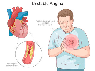 Wall Mural - symptoms of unstable angina and blockage in coronary arteries causing chest pain and shortness of breath diagram hand drawn schematic raster illustration. Medical science educational illustration