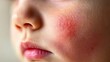 © 海翰 章 - child's Face with Redness and Irritation Caused by Antibiotics Allergy.Pediatric skin conditions,allergic reactions,infant health,Healthcare,pharmaceuticals,dermatology,pediatrics,baby care products.