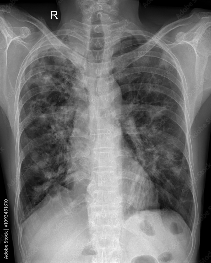 Chest PA Radiograph for Evaluation of Lung Disease and Pulmonary ...