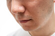 © Taro - いちご鼻のクローズアップ：30代男性の毛穴と角栓