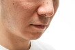 © Taro - いちご鼻のクローズアップ：30代男性の毛穴と角栓