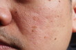 © TS.PHOTOS - Closeup of red skin with acne, pores and moles on the face of a young Asian man Human health and aesthetics concept