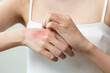 © Pormezz - Dermatology, asian young woman reaction from atopic, insect bites on her arm, hand in scratching itchy red spot or rash of skin. Healthcare, treatment of beauty.