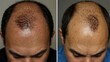 © claudunia - Last before-and-after photo of a hair loss treatment process.