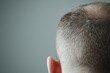 © HadK - Understanding psoriasis a closeup examination of scalp skin affected by autoimmune conditions