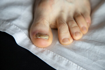 A close-up of a damaged toenail after trauma, bruise, photographed indoors on a fabric background. Concept of personal hygiene and the care of nail health and recovery from damage or infection.