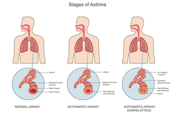 Asthma is a chronic condition causing airway inflammation, wheezing, coughing, and breathlessness