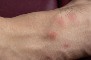 The blisters are red and itchy on the patient's skin that are caused by bites from pet fleas