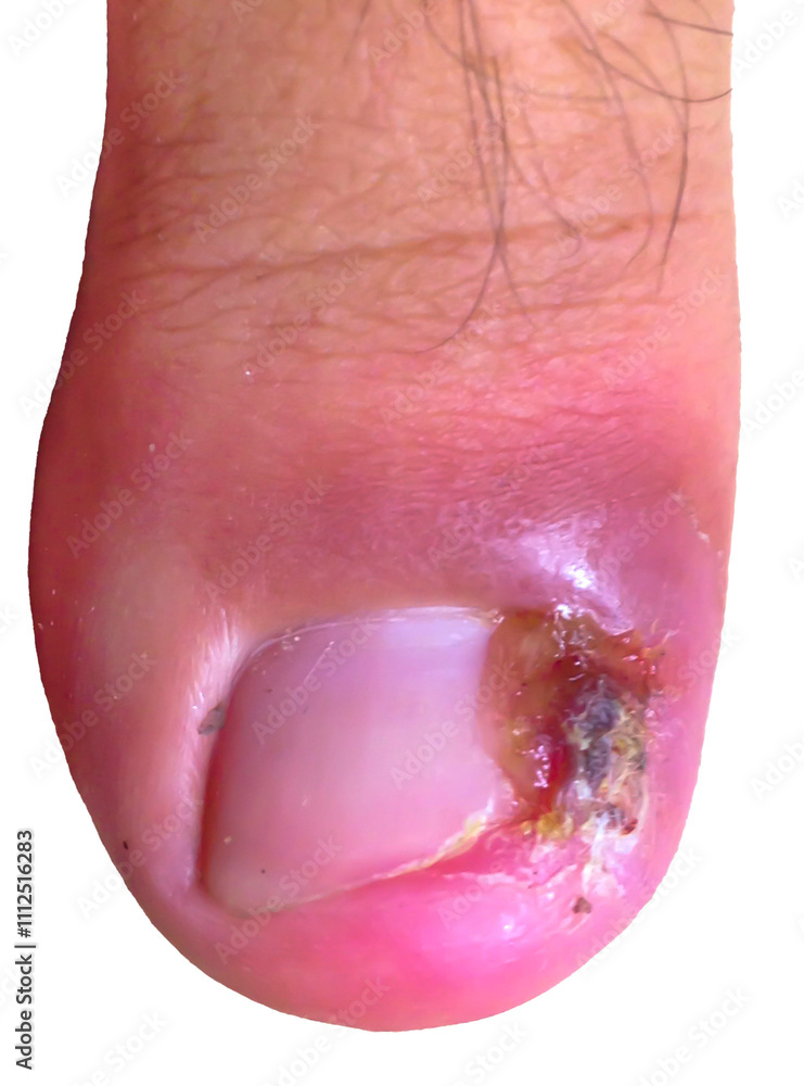 Ingrown nails or Ingrown toenails,by bacteria causing inflammation A ...