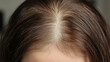 © whoopwhoops - women head scalp with hair loss,represent hair loss pattern symptoms on woman