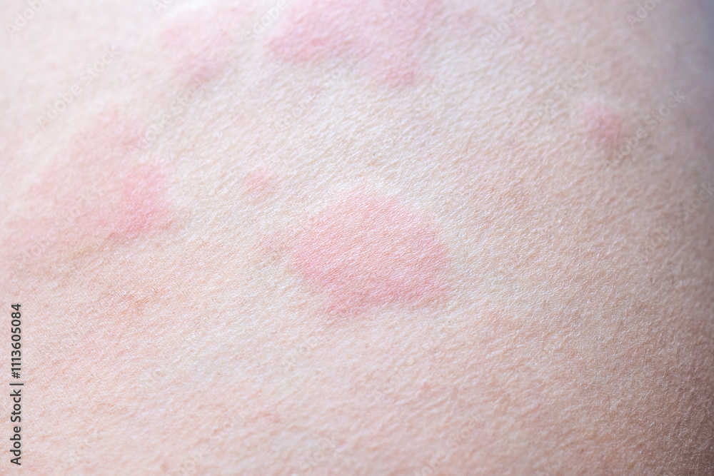 Skin allergy rash dermatitis texture close up Stock Photo | Adobe Stock