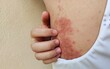 © Rung Kh - portrait the rash, hives, allergy and inflammation skin, reaction and urticaria, eczema and epidermis, allergic and psoriasis on the back, health care and medical concept.