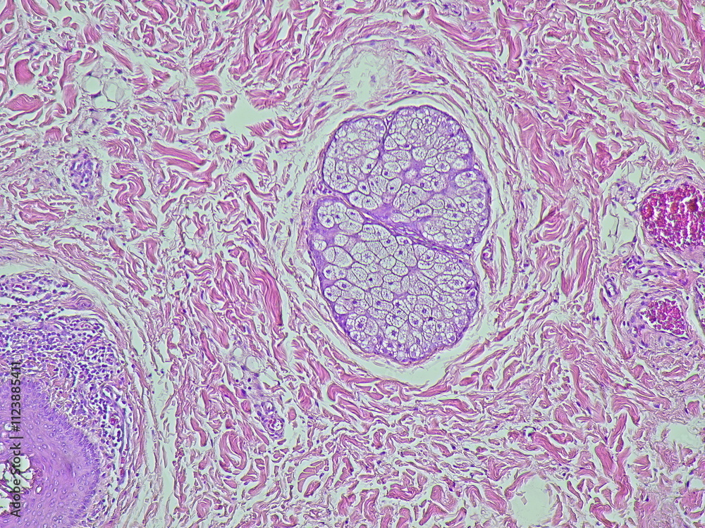 Lobulus Ear Photomicrograph showing histology of a atheroma cyst on the lobulus ...