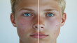 © Herseliia - White European Blonde Man, Treatment Dermatology, Cosmetology Beauty Procedures, Freckles, Acne, Before and After Banner