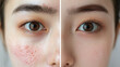 © Herseliia - Cosmetology Beauty Procedures, Asian Woman, Treatment Dermatology, Acne, Before and After Banner
