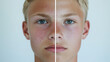 © Herseliia - White European Blonde Man, Treatment Dermatology, Cosmetology Beauty Procedures, Freckles, Acne, Before and After Banner