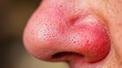 © yang - Close up of red irritated nose, emphasizing the discomfort and struggle of allergies or cold symptoms, highlighting the human vulnerability and resilience in the face of common ailments.