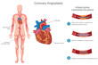 © Nandalal - Coronary angioplasty is a minimally invasive procedure to open blocked heart arteries using a balloon and stent, improving blood flow and reducing heart attack risk