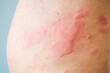 © Kwangmoozaa - Skin allergy rash dermatitis texture close up background