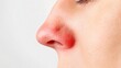 © 为轩 张 - Close up of red irritated nose, emphasizing the discomfort and struggle of allergies or cold symptoms, highlighting the human vulnerability and resilience in the face of common ailments.