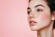 © AI PP - Sad young girl with acne problem on her face. Generative Ai.