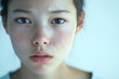 © AI PP - Sad young girl with acne problem on her face. Generative Ai.
