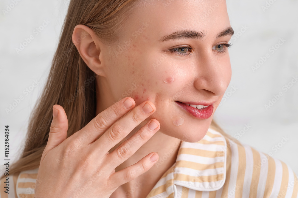 Young woman with acne problem and applied pimple patches on light background, closeup