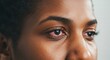 © Passion - Close-up of african female with eye irritation and red eye symptoms