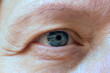 © lesslemon - middle aged female's face with drooping eyelid eyes. Ptosis is a drooping of the upper eyelid, lazy eye, first wrinkles