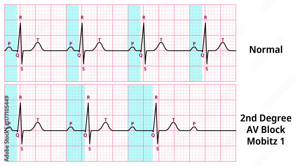 Comparison Of AV Block Degree 2 Mobitz Type 1 And Normal ECG Waveforms 