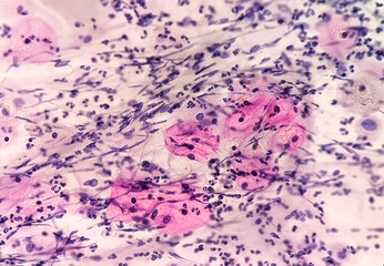 Paps smear: NILM with reactive cellular changes associated with inflammation.