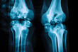 © enter - Analyzing Knee Joint X-Rays:  Structure,  Diagnosis, and Treatment Options for Osteoarthritis