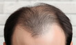 © emilio100 - Man suffering from hair loss, Hair loss concept, generated ai