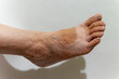 © Serhii - Visible veins on a foot with uneven skin tone in natural lighting
