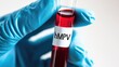 © Ketanoff - A hand in a blue glove holds a test tube labeled hMPV, containing blood. This is part of ongoing research on metapneumovirus in China during 2025